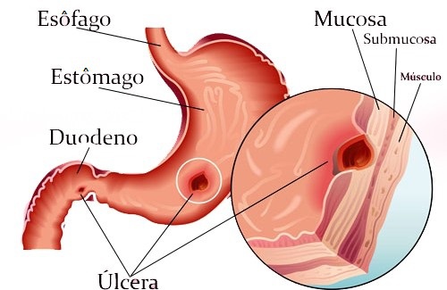 Tratamento natural contra as úlceras gástricas