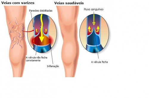 Varizes
