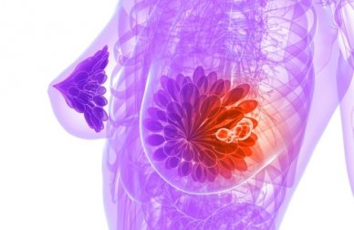 Como detectar precocemente o câncer de mama?