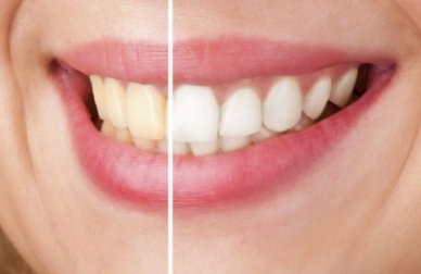 Como clarear os dentes naturalmente?