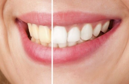 Como clarear os dentes naturalmente?
