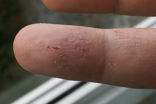 eccema5