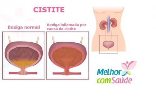 dor ao urinar
