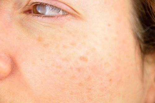 Confira dicas naturais para remover as manchas na pele