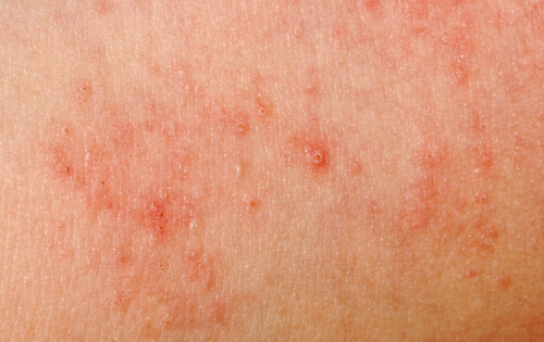 As 10 alergias mais comuns da pele