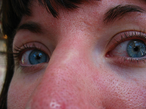 Eliminar cravos naturalmente