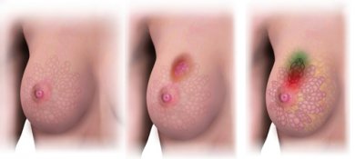 Você sabia que 4 em cada 10 tumores podem ser prevenidos?