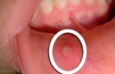 Como curar aftas e feridas na boca?