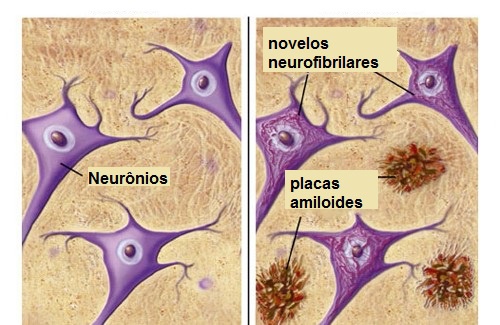 Alimentos que nos protegem do Alzheimer