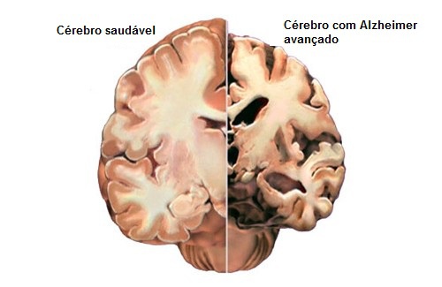 Como detectar a tempo os primeiros sintomas do Alzheimer?