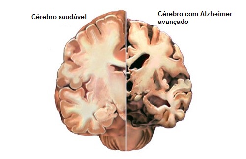 Alzheimer1-500x325-1