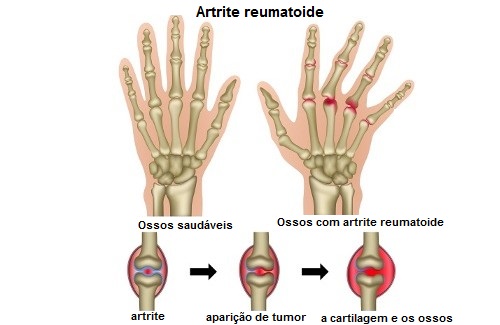 Quais são os gatilhos da artrite reumatoide? Quais são os gatilhos da artrite reumatoide?