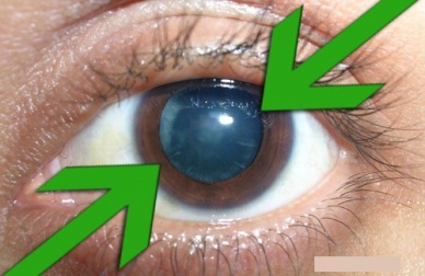 Prevenção e tratamento natural da catarata