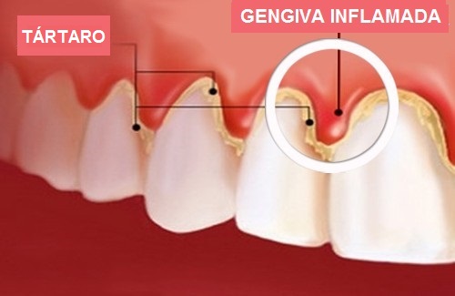 Tratamento natural para gengivite ou gengiva sangrenta Tratamento natural para gengivite ou gengiva sangrenta
