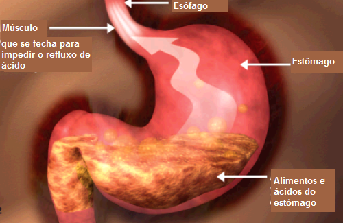 Dieta adequada para pessoas com refluxo gastroesofágico