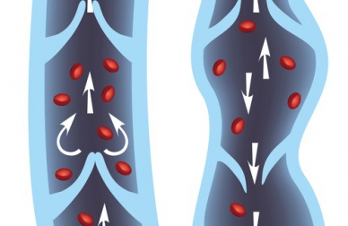 Os 10 melhores remédios para as varizes
