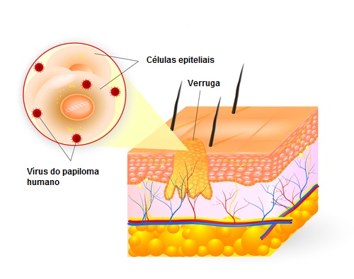 Verruga