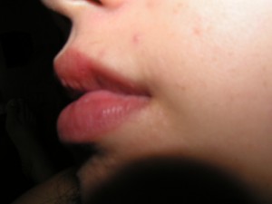 Remédios naturais para o tratamento de aftas e feridas