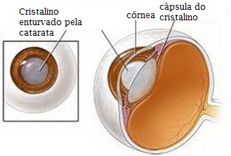Cristalino enturvado pela catarata