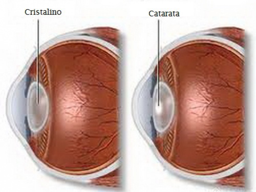 Como a catarata se desenvolve