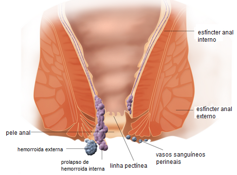Ilustração de como as hemorroidas acontecem