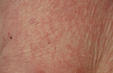 Alimentos e suplementos para a pele seca e desidratada