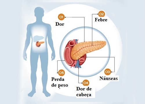 Pâncreas inflamado: sintomas que você deve conhecer