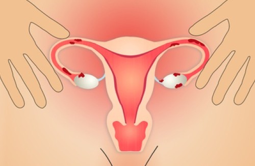 Causas e remédios para a endometriose Causas e remédios para a endometriose