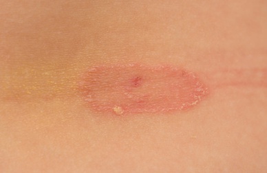 Como prevenir os fungos da pele?