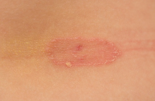 Como prevenir os fungos da pele?