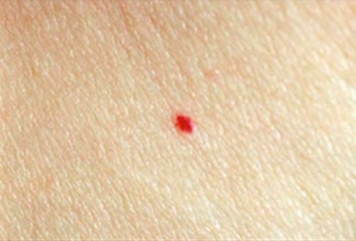 manchas vermelhas na pele