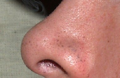 7 dicas para eliminar os cravos rapidamente