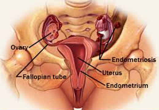 Útero com endometriose