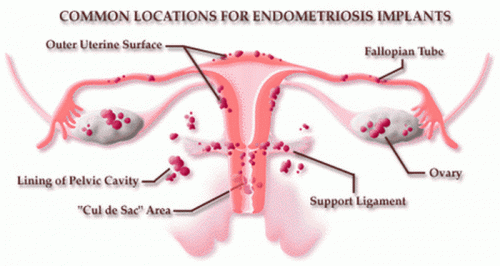 Endometriose