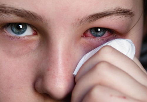 Olhos vermelhos causados por alergias