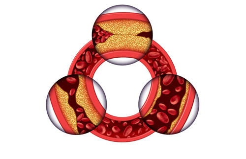 Colesterol na mulher