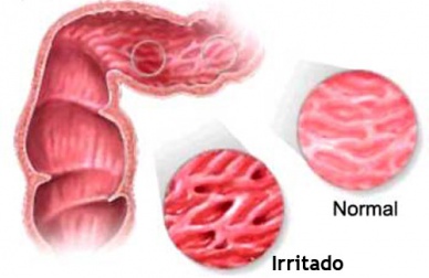 Infusões para aliviar o cólon irritável