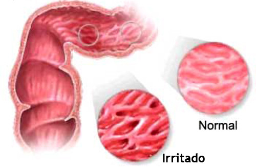 Dieta para a síndrome do intestino irritável