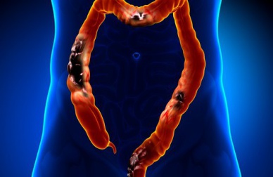 Diverticulite: alimentos que devem ser evitados