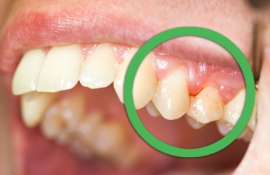 Remédios naturais para o sangramento na gengiva ou dentes soltos