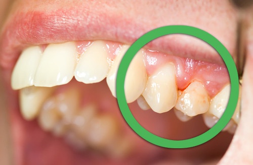 Remédios naturais para o sangramento na gengiva ou dentes soltos