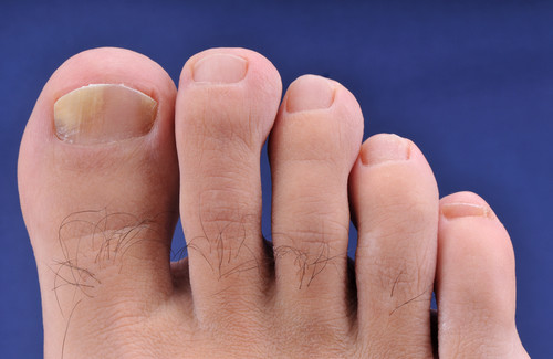 Remédios caseiros para a onicomicose (mãos e pés) Remédios caseiros para a onicomicose (mãos e pés)