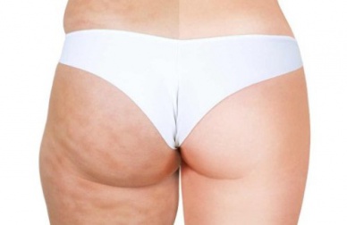 6 alimentos que causam celulite