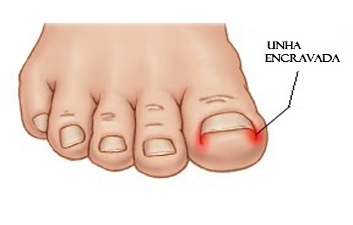 Como evitar unhas encravadas? Como evitar unhas encravadas?