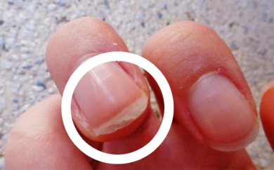 Descamação das unhas: causas e tratamentos