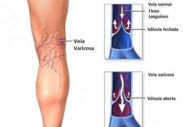 Dicas para aliviar a dor de varizes