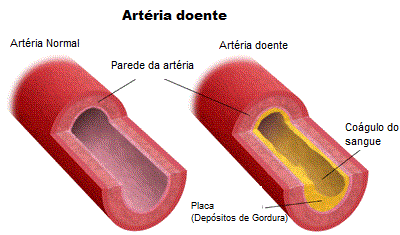 arteriosclerose