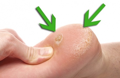 Como acabar com os calos nos pés?