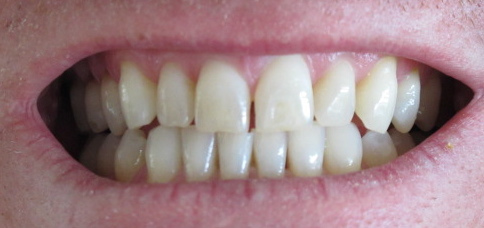 Como clarear os dentes