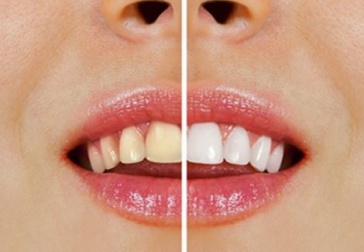 Como clarear os dentes com produtos naturais?